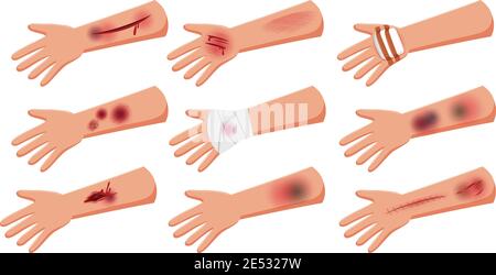 HEMATOMA, DRAWING Stock Photo - Alamy