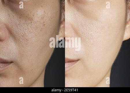 two pictures compare effect Before and After treatment. skin with problems of freckles , pore , dull skin and wrinkles before and after treatment Stock Photo