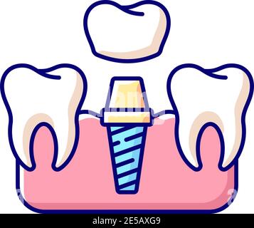 Dental implants procedure RGB color icon Stock Vector