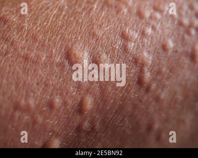 Symptoms of contact allergy on skin. Close up of hives. Stock Photo