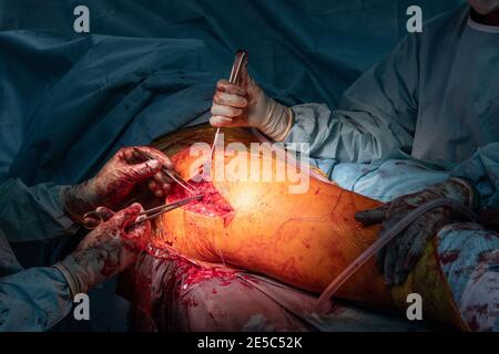 a doctor operates on a fracture of the femur in an operating room in a hospital Stock Photo