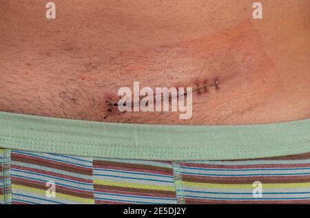 Hernia scar, post operative inguinal hernia scar Stock Photo