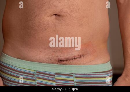Hernia scar, post operative inguinal hernia scar Stock Photo