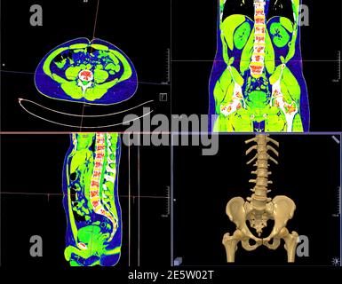 Collection of CT Lumbar spine or L-S spine 3D rendering image AP , coronal , sagittal view and 3D rendering  . Stock Photo