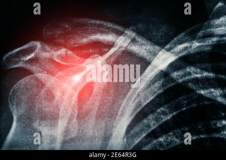 X-ray of shoulder, roentgen picture of human bones of skeleton and red spot as symbol of illness and pain. Stock Photo