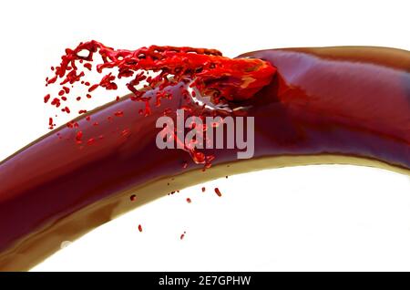 Hemorrhagic stroke. An artery ruptures, causing more or less extensive bleeding and damaging brain tissue. Brain damage. Neurology. Type of stroke Stock Photo