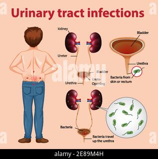 Informative illustration of urinary tract infections illustration Stock Vector