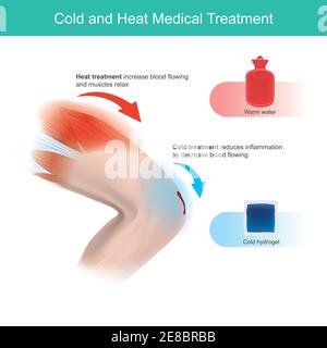 Cold and Heat Medical Treatment. This graphic explain human leg 2 different pain and injury include the first aid treatment. Stock Vector
