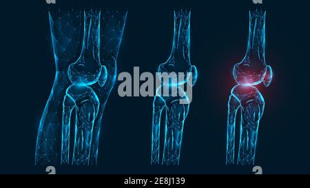 Polygonal vector illustration thigh and knee joint side view. Disease, pain, and inflammation of the knee joint. Low poly model of a healthy and injur Stock Vector