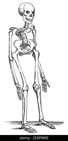 Human skeleton with rickets. Illustration of the 19th century. Germany ...