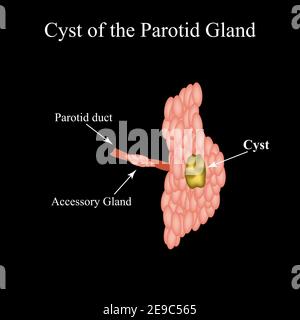 Parotid salivary gland cyst. The structure of the parotid salivary gland. Vector illustration on isolated background Stock Vector