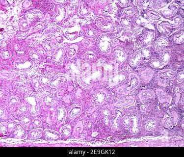 Testicle in a case of Klinefelter (XXY) syndrome. The testicle shows a diffuse hyalinization and fibrosis of the seminiferous tubules and  hyperplasia Stock Photo