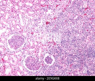 Renal cortex affected by a chronic pyelonephritis. The renal parenchyma in the right half of the image shows an intense infiltrate of chronic inflamma Stock Photo