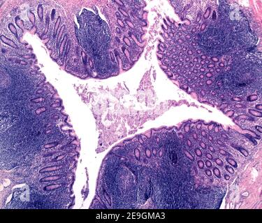 Light micrograph of the mucosa of a very inflamed human vermiform appendix, showing numerous lymphoid follicles and aggregations of inflammatory cells Stock Photo