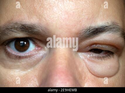 The Inflammation of the eyelid. Swelling of the eye after insect bite. A man with sick eyes. Sensitive reaction to an experimental wrinkle cream. Stock Photo