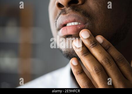 African American Mouth Lip Skin Herpes Treatment Stock Photo