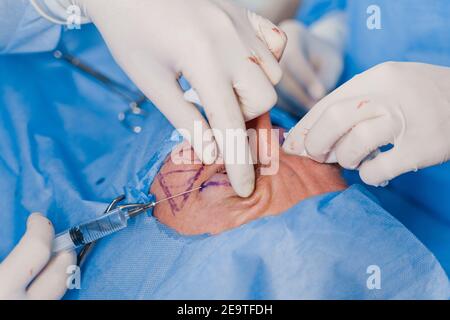 Close-up anesthesia before blepharoplasty and lipofilling plastic surgery operation for modifying the eye region of the face in medical clinic. Surgeo Stock Photo