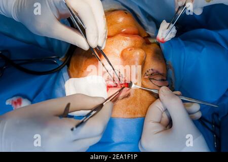Transconjunctival blepharoplasty. Surgery. Upper blepharoplasty. Surgeon do plastic operation. 2 surgeons removing piece of skin from eyelid Stock Photo