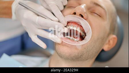 Patient with dental braces during a regular orthodontic visit Stock Photo