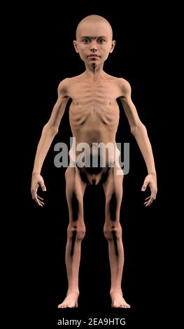 Undernourished child. Problems of food shortage. 3d render. Human anatomy Stock Photo