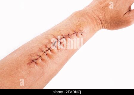 Surgery wound fix with staple on arm,isolated on white background. Stock Photo