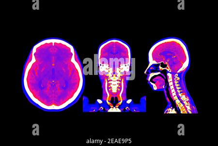 colorful of CT angiography of the brain or CTA brain Coronal view Stock ...