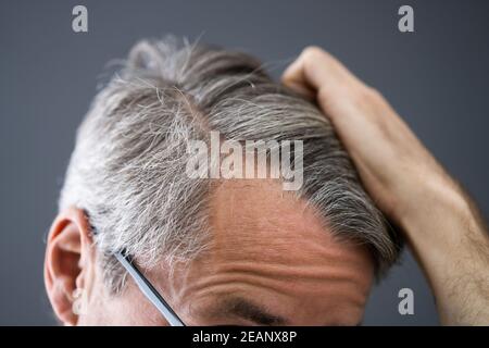 Balding Man Losing Hair Stock Photo