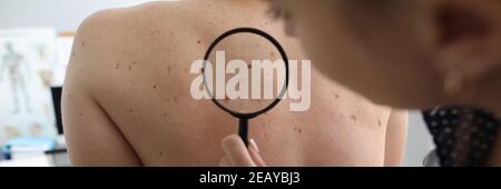 Doctor oncologist with magnifying glass in his hand examines pigmented nevi on patient's back in clinic Stock Photo