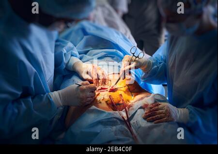 Close up of doctors in surgical suits performing abdominoplasty surgery in clinic. Male plastic surgeon and female assistant doing abdominal plastic surgery. Concept of tummy tuck and cosmetic surgery Stock Photo
