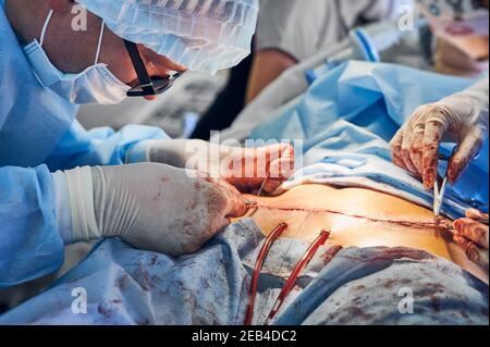 Close up of male surgeon in sterile gloves placing sutures after tummy tuck surgery. Man doctor performing abdominal plastic surgery in the hospital. Concept of abdominoplasty and cosmetic surgery. Stock Photo