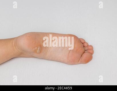 Plantar wart close up on the bottom of a female foot heel caused by the human papillomavirus, or HPV. Stock Photo