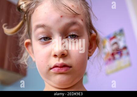 Portrait of sad child girl with virus of varicella has measles, chicken pox, rubella all over the body. Viral Diseases Stock Photo