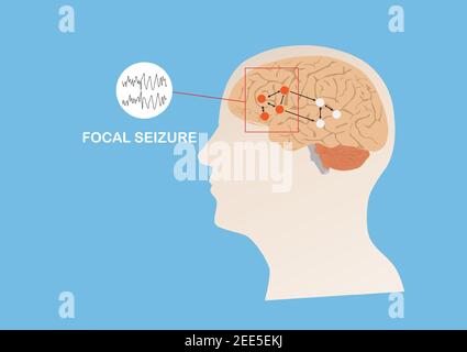 Illustration of abnormal eletrical activity in region of human brain causing focal seizure or epilepsy. Human brain and blue background.