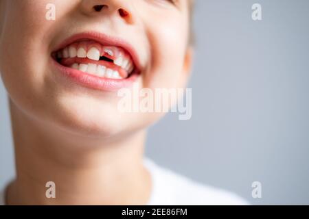 Boy without milk upper tooth in white t-shirt on the gray background. Close up. Stock Photo