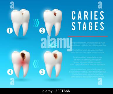 Tooth decay 3d vector poster. Teeth on different stages of dental caries development. Enamel and dentin decay, pulp decay and pulp infection banner fo Stock Vector