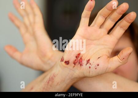 Wounds on the inside of the palm of an adult male's right hand after removing the bandages. Close-up. Stock Photo