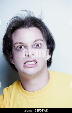 Portrait of a young man with a bruised eye Stock Photo