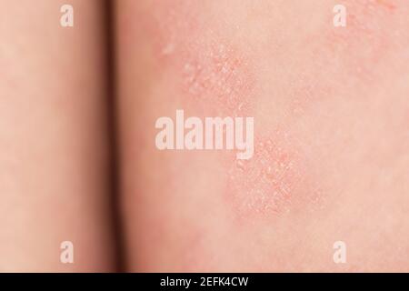 Close-up severe atopic eczema on the legs behind the knees of a child is a dermatological disease of the skin. Large, red, inflamed, scaly rash on the Stock Photo