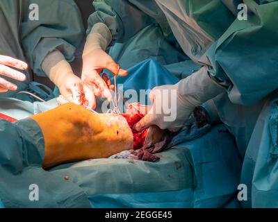 in an operating room lower leg amputation is performed Stock Photo