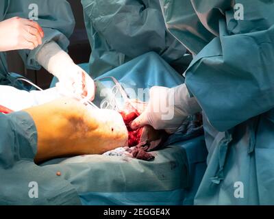 in an operating room lower leg amputation is performed Stock Photo