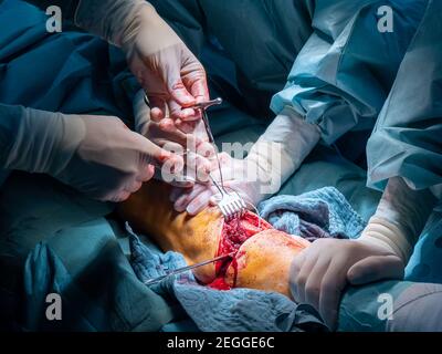 in an operating room lower leg amputation is performed Stock Photo