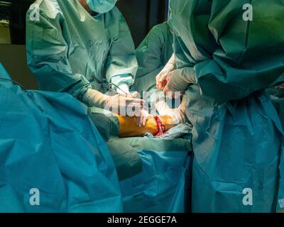 in an operating room lower leg amputation is performed Stock Photo