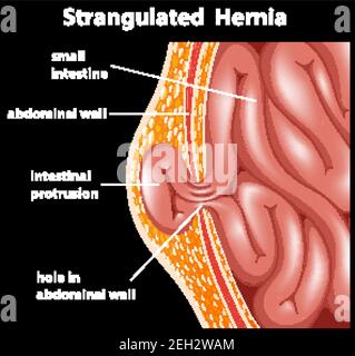 Strangulated hernia anatomy diagram illustration Stock Vector Image ...