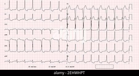 ECG example of a pathological 12-lead rhythm, supraventricular premature beat Stock Photo