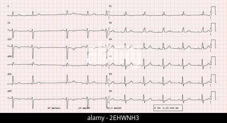 ECG example of a pathological 12-lead rhythm, atrial fibrillation Stock Photo