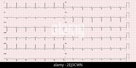 ECG example of a normal 12-lead sinus rhythm Stock Photo