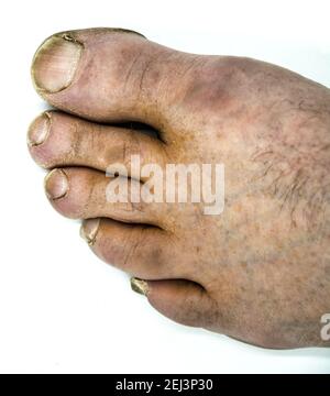 Close up of male foot and dirty long toe nail isolated Stock Photo