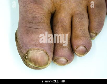 Close up of male foot and dirty long toe nail isolated Stock Photo