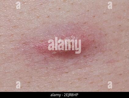 Acne pimple on Caucasian skin beginning to scab and heal over. Macro image of infection and healing process. Health and medical problems. Stock Photo