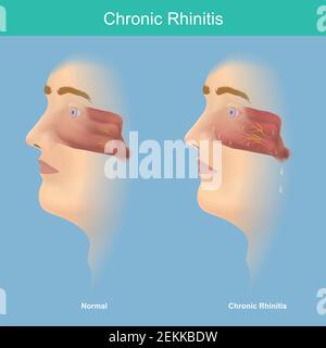 Chronic Rhinitis. This illustration medical use for explain comparison chronic rhinitis symptoms have mucus in the nose and throat. Stock Vector